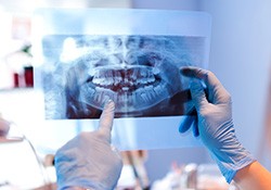 Dental team looking at X-ray for root canal patient