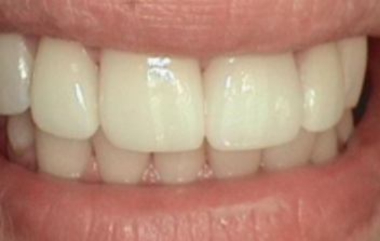 Flawless smile after cosmetic dentistry