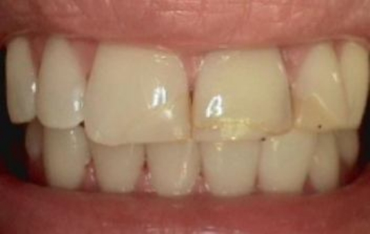 Yellowed teeth before cosmetic dentistry
