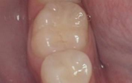 Closeup of teeth with tooth colored fillings replacing metal