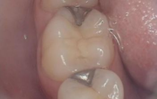 Closeup of teeth with metal fillings