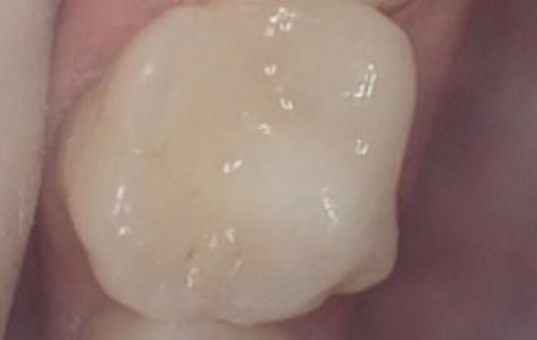 Repaired tooth after dental restoration
