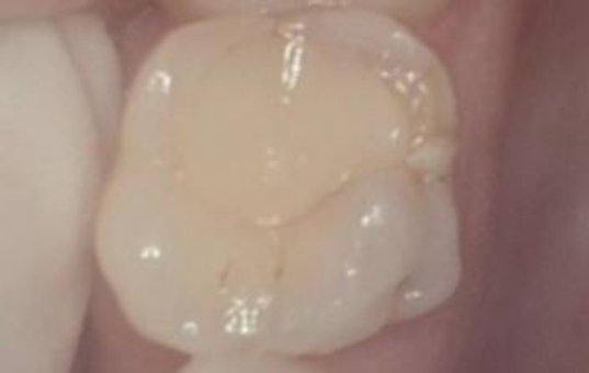 Damaged tooth before dental restoration