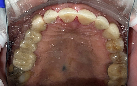 Closeup of healthy smile after dental restoration and tooth replacement