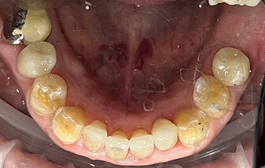 Closeup of smile after repairing dental wear