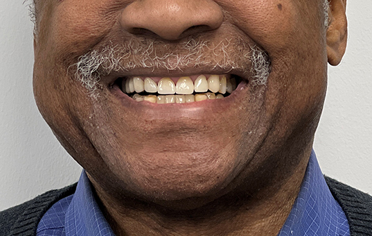 Closeup of smile after replacing damaged teeth