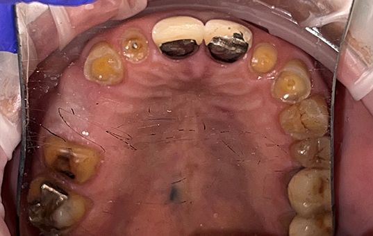 Closeup of smile with extensive damage and several missing teeth