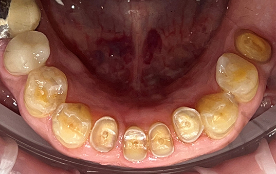 Closeup of teeth with severe dental wear