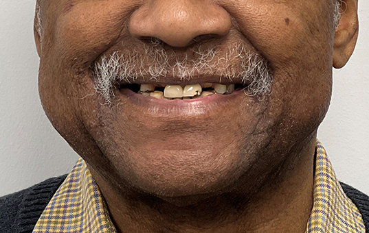 Closeup of smile with several damaged teeth