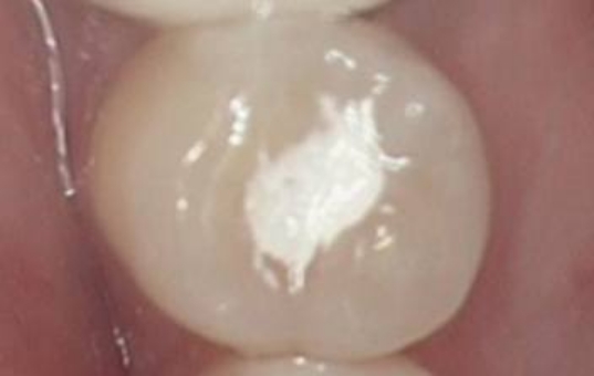Tooth with damage and discoloration