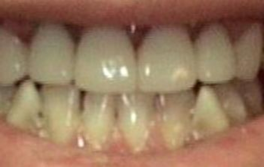 Closeup of flawlessly repaired smile