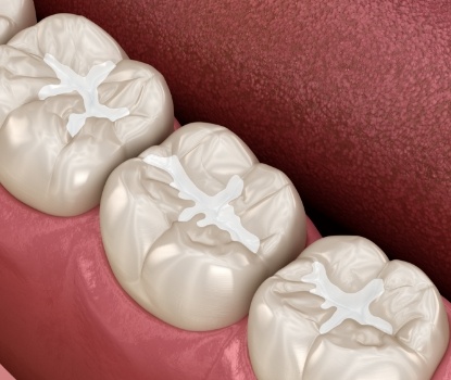Aniamted smile with dental sealants