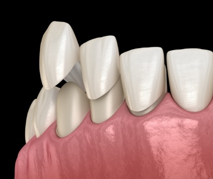 Animated smile during veneers placement