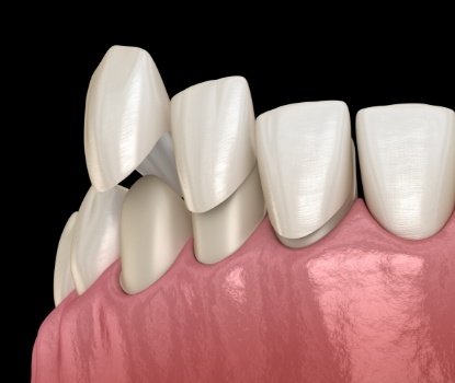 Animated smile during veneers placement