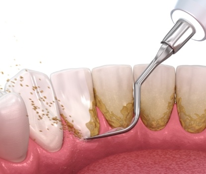 Animated smile during scaling and root planing treatment