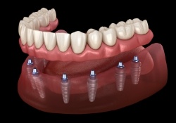 Animated smile during dental implant supported denture placement