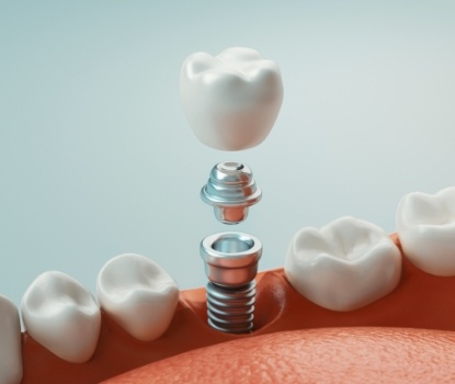 Animated smile showing the four step dental implant process