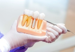 Dentist pointing to smile model during initial dental implant consultation