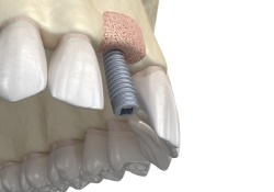 Animated smile showing dental implant osseointegration