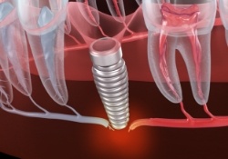 Animated smile showing dental implant restoration