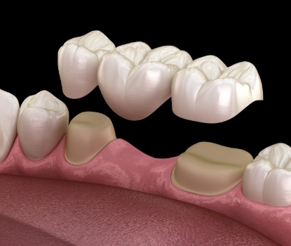 Animated smile during dental bridge placement