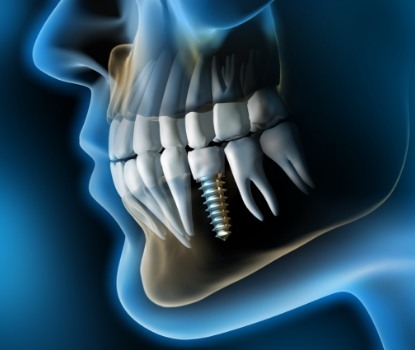 Animated smile with dental implant supported replacement tooth