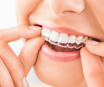 Closeup of dental patient placing Invisalign clear braces tray