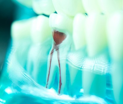 Closeup of damaged tooth in lower arch