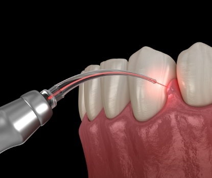 Animated smile during soft tissue laser dentistry treatment