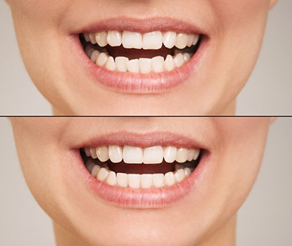 Before and after veneers