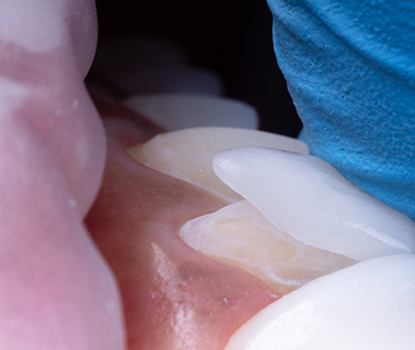 Up close view of a patient receiving veneers