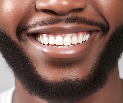 Up close image of a person’s smile with veneers