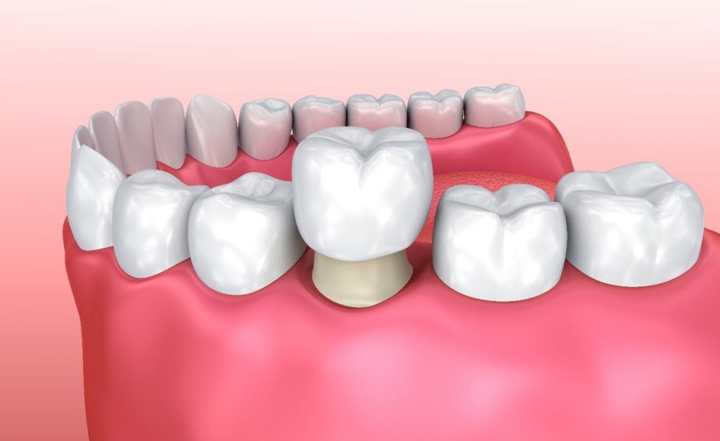 artwork of dental crown