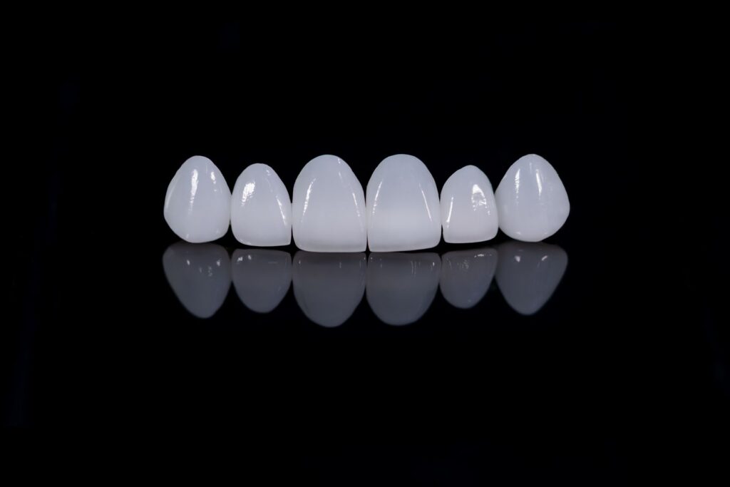 Porcelain veneers