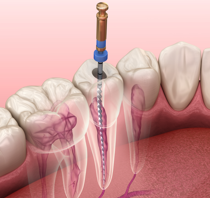 Illustration of a root canal cross-section